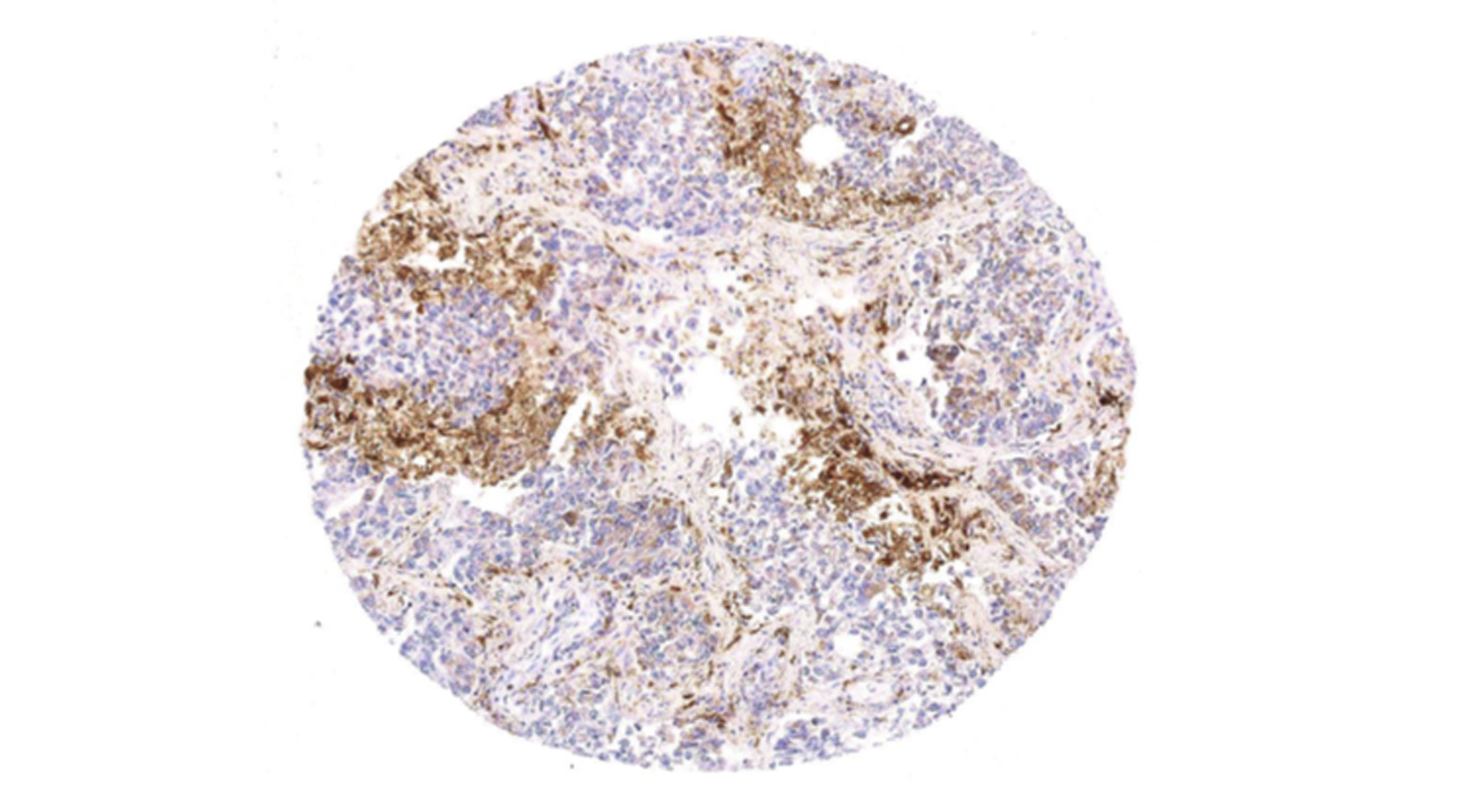肺癌活检中的细胞核（染为紫色）及与肿瘤相关的巨噬细胞（染为棕色）<em>（由受访者截图展示）</em>