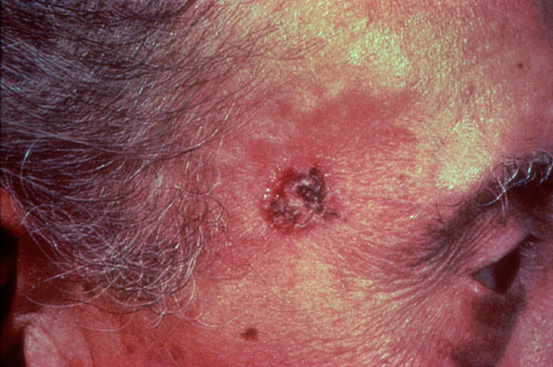 Best Treatment for Sebaceous Hyperplasia? - RealSelf.com