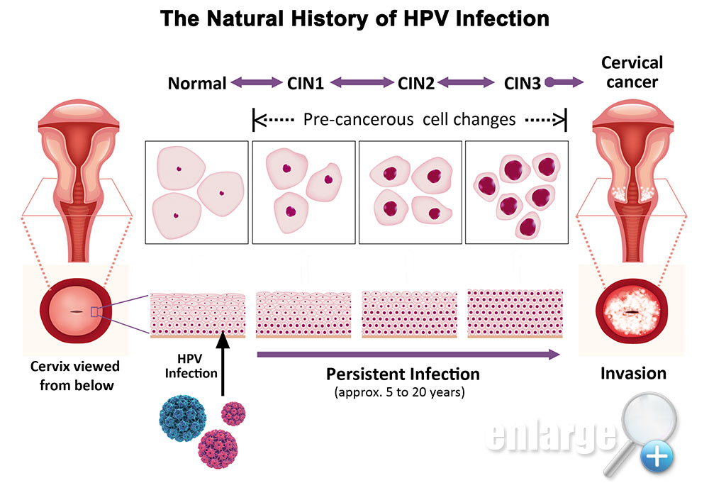 can hpv cause womb cancer