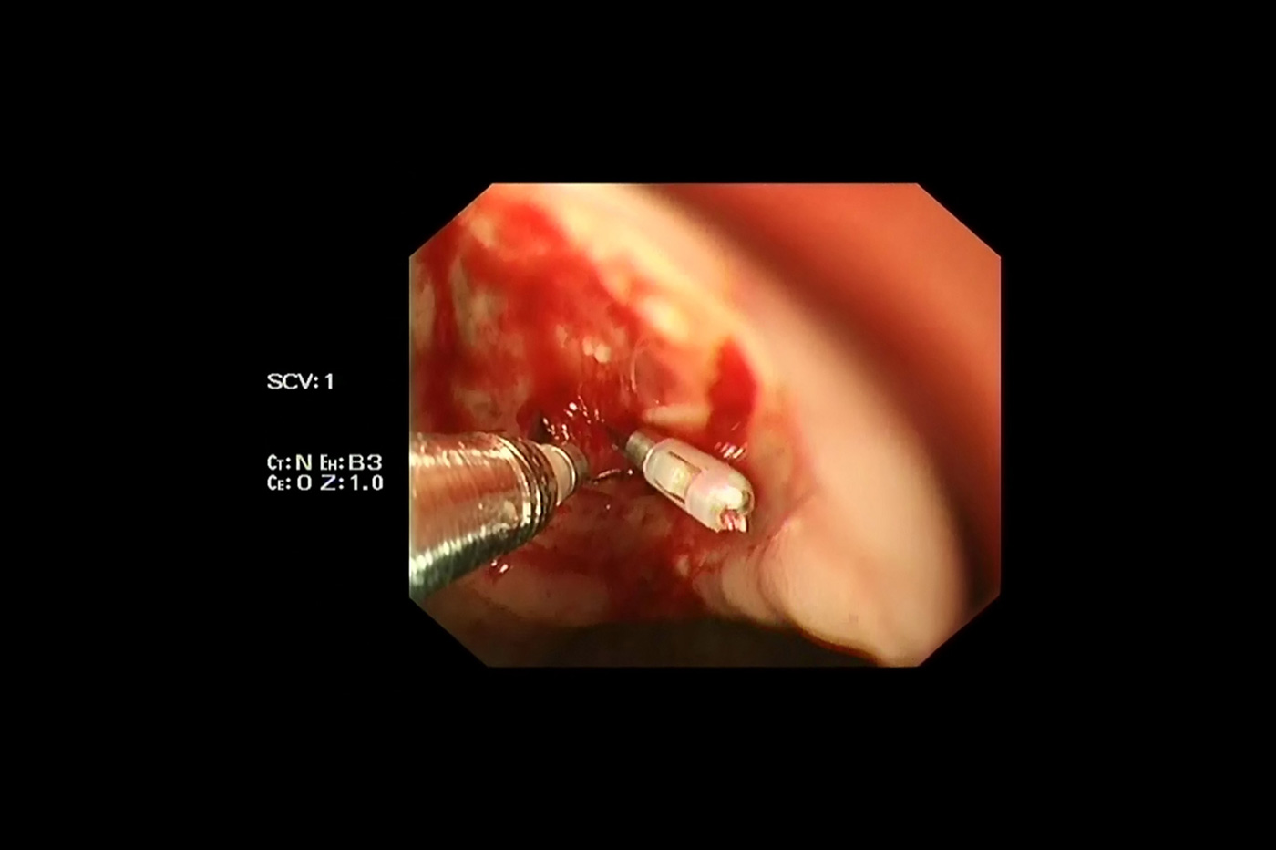 Endoscopic hemostasis, an endoscopic therapy involving surgery through endoscope with various techniques and tools, is an effective means to control bleeding in ulcers