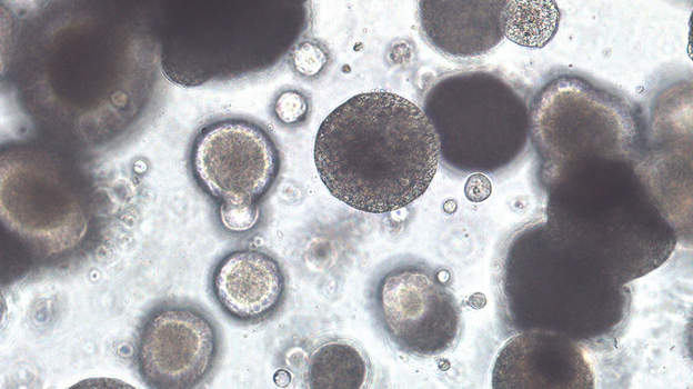 CUHK launches Asia’s first organoid biobank for bladder cancer: Transforming cancer treatment with customised organoids for personalised drug testing